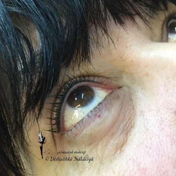 Межресничка.