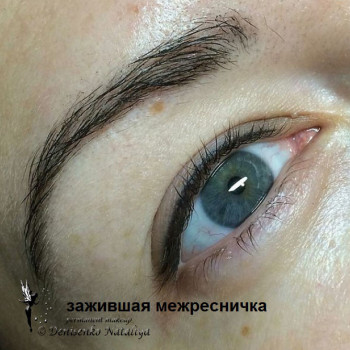 Межресничка.