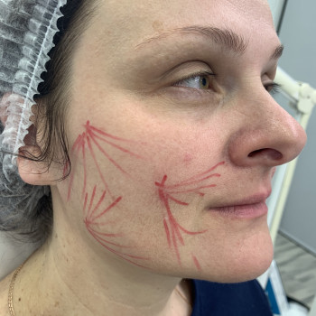 Векторний ліфтинг препаратом Radiesse
                    Врач-косметолог Марина Черкассы