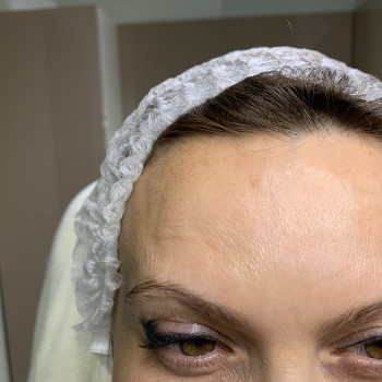 Плазмоліфтинг або плазмотерапія (PRP)
                    Врач-косметолог Марина Черкассы