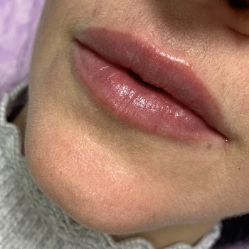 Корекція обʼєму та форми губ
                    Врач-косметолог Марина Черкассы