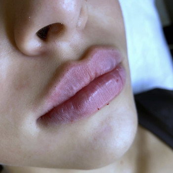 Корекція обʼєму та форми губ
                    Врач-косметолог Марина Черкассы