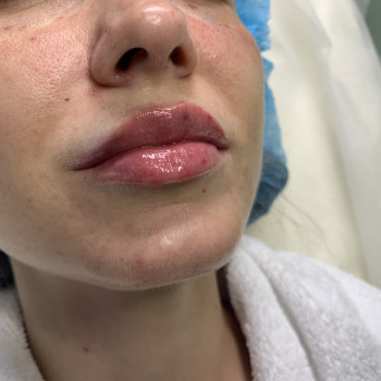 Корекція обʼєму та форми губ
                    Врач-косметолог Марина Черкассы