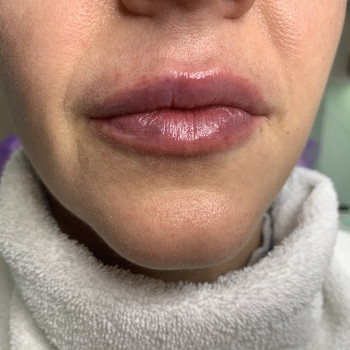 Корекція обʼєму та форми губ
                    Врач-косметолог Марина Черкассы