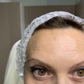 Корекція мімічних зморшок ботулотоксином (ботулінотерапия) або ботокс- Ксеомин, Ботокс
                    Преподаватель курсов красоты Марина Черкассы