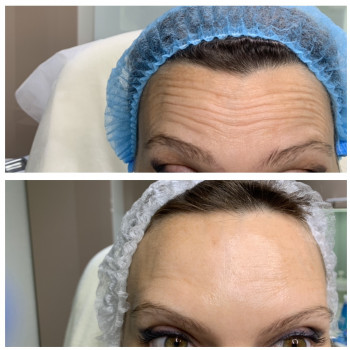 Корекція мімічних зморшок ботулотоксином (ботулінотерапия) або ботокс- Ксеомин, Ботокс
                    Преподаватель курсов красоты Марина Черкассы