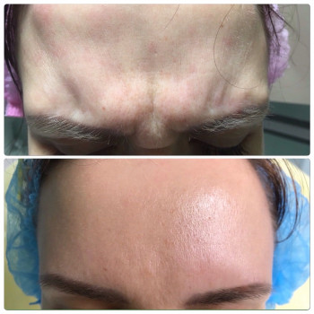 Корекція мімічних зморшок ботулотоксином (ботулінотерапия) або ботокс- Ксеомин, Ботокс
                    Преподаватель курсов красоты Марина Черкассы