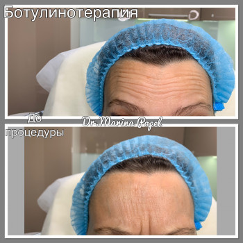 Корекція мімічних зморшок ботулотоксином (ботулінотерапия) або ботокс- Ксеомин, Ботокс
                    Преподаватель курсов красоты Марина Черкассы