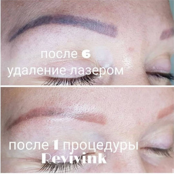 Удаление татуажа
                    Мастер перманентного макияжа Юлия Лисицына Днепр