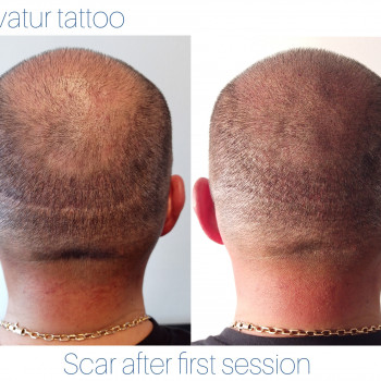 трихопигментация , Микропигментация головы, камуфлирование ш