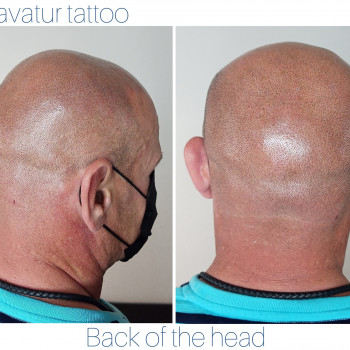 трихопигментация , Микропигментация головы