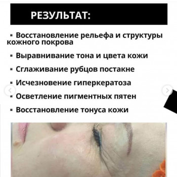 Биоревитализирующий пилинг. Всесезонный дермальный пилинг
                    Косметологический центр DIA BEAUTY Киев