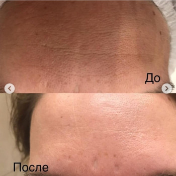 Биоревитализирующий пилинг. Всесезонный дермальный пилинг
                    Косметологический центр DIA BEAUTY Киев