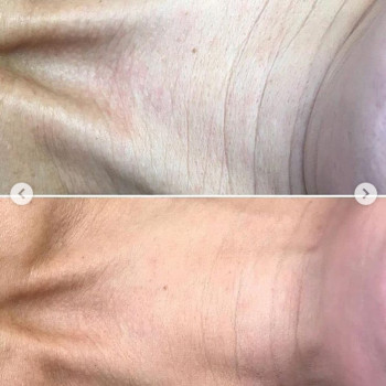 Биоревитализирующий пилинг. Всесезонный дермальный пилинг
                    Косметологический центр DIA BEAUTY Киев