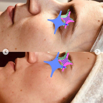 Биоревитализирующий пилинг. Всесезонный дермальный пилинг
                    Косметологический центр DIA BEAUTY Киев