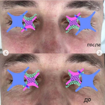 Биоревитализирующий пилинг. Всесезонный дермальный пилинг
                    Косметологический центр DIA BEAUTY Киев
