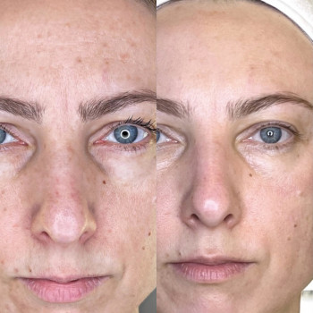 Пилинги поверхностные внесезонные
                    Косметолог Kateryna Одесса