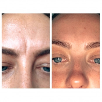 Пилинги поверхностные внесезонные
                    Косметолог Kateryna Одесса