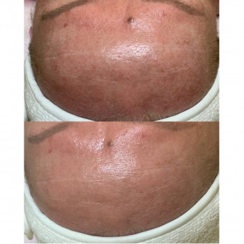 Пилинги поверхностные внесезонные
                    Косметолог Kateryna Одесса