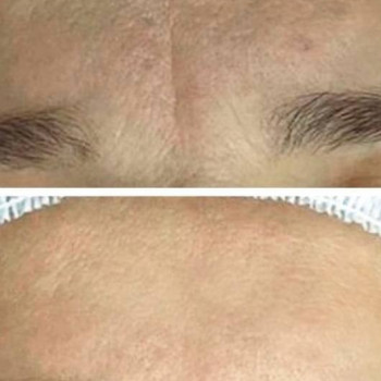 Пилинги поверхностные внесезонные
                    Косметолог Kateryna Одесса