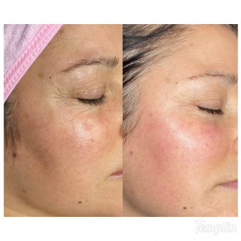 Пилинги поверхностные внесезонные
                    Косметолог Kateryna Одесса