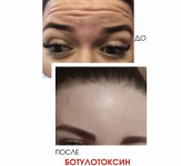 Ботокс 3 зони + біоревіталізація всього обличчя Парикмахерская Надия Кривой Рог