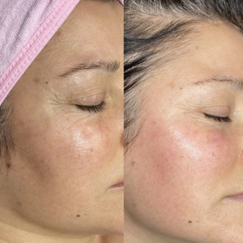 Мезотерапия без боли и реабилитации
                    Косметолог Kateryna Одесса