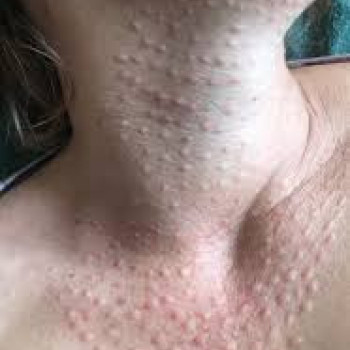 Бустер папульное введение!