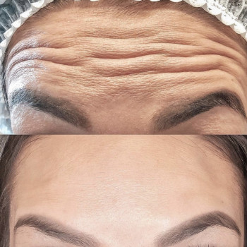 Ботокс горизонтальних зморшок чола