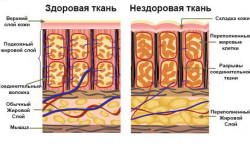 Антицеллюлитный массаж живота Массажист Алекс Одесса