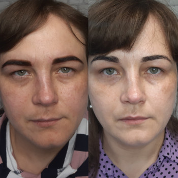 Процедура mesolift(мезотерамия+Миндальный пилинг)