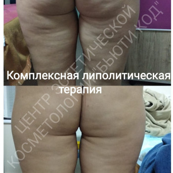 Ін'єкційна/безопераційна ліпосакція