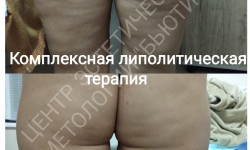 Безопераційна ліпосакція/Ферментотерапія Косметолог-инъекционист Светлана Сумы