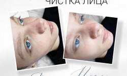 Механическая чистка лица Косметолог Яна Дніпро