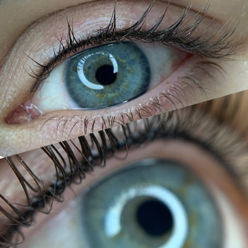 Межресничка