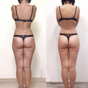 Уменьшение локальных жировых отложений