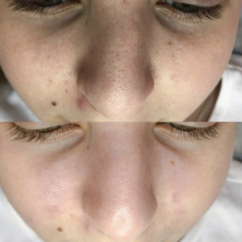 Чистка лица для подростков