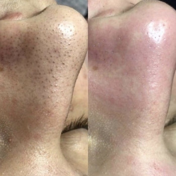 Мужская чистка лица