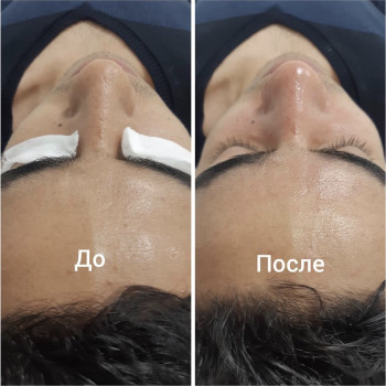 Мужская чистка лица
