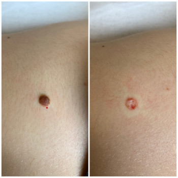 Лазерне видалення доброякісних новоутворів (папіломи, бородавки, гемангіоми)
                    Косметологический центр Клініка естетичної медицини Мирослави Новосільської Ужгород