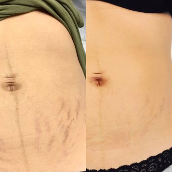 лазерне видалення розтяжок на животі. фото до після