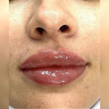 Контурная пластика губ