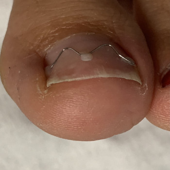 Коррекция деформированных ногтей
                    Подолог Юлия Днепр