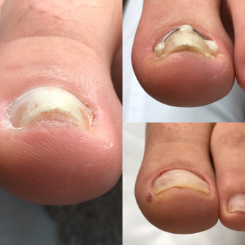 Коррекция деформированных ногтей
                    Подолог Юлия Днепр