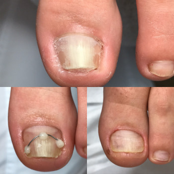 Коррекция деформированных ногтей
                    Подолог Юлия Днепр