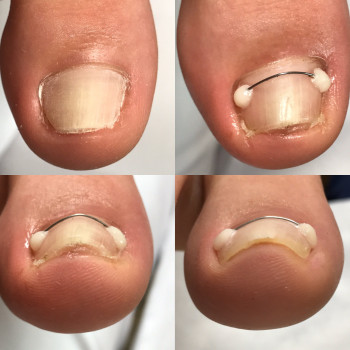 Коррекция деформированных ногтей
                    Подолог Юлия Днепр