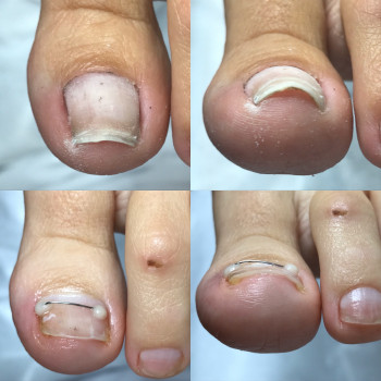 Коррекция деформированных ногтей
                    Подолог Юлия Днепр