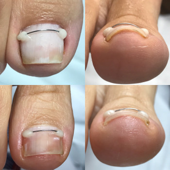 Коррекция деформированных ногтей
                    Подолог Юлия Днепр