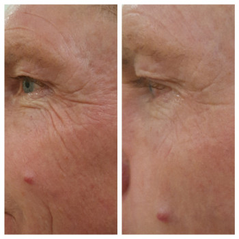  
 
Коррекция орбитальной области у мужчин.
До и После Smas