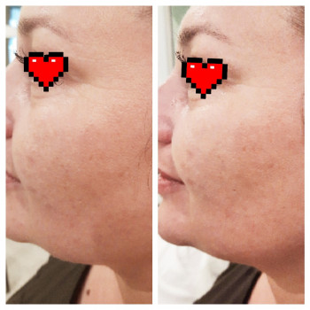   
Коррекция второго подбородка
До и После 
Smas Ulthera system